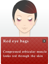 Red eye bags